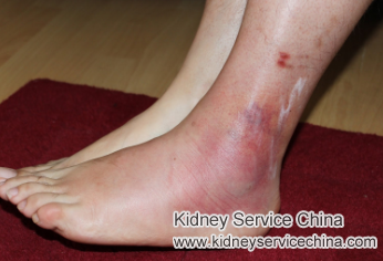 How to Ease Purple Foot for Diabetic with 40% Kidney Function