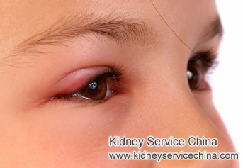 How to Manage Puffy Eyes and Belly with Lupus Nephritis