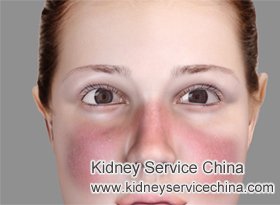 Malar Rash on Face and Lupus Nephritis