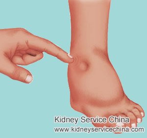 Swelling on Legs with Diabetic Nephropathy