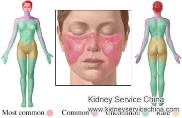 An Effective Treatment for Lupus and Kidney Atrophy