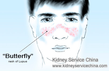 Creatinine Reaches to 800 with Lupus Nephritis