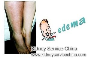 Swelling in legs and abdomen