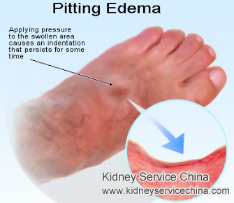 Pedal Edema in Diabetic Nephropathy: Causes and Treatment