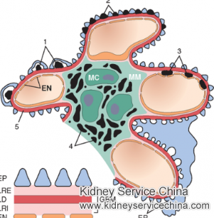 How to Prevent Lupus Nephritis from Aggravating into Kidney Failure