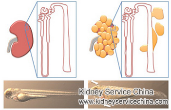 Chinese Herbs to Shrink Right Renal Cortical Cyst