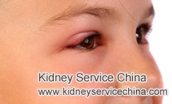 Why Is Eyelid Swelling First Noticed in Nephrotic Syndrome Patients