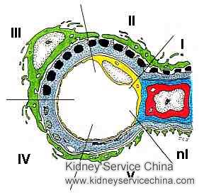 Micro-Chinese Medicine Osmotherapy for Membranous Nephropathy