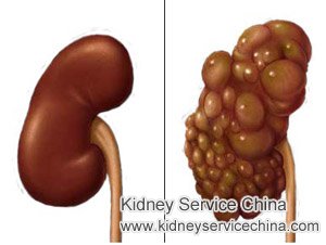 How to Ease Back Pain with Multiple Kidney Cysts