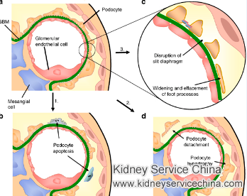 Proteinuria for Nephrotic Syndrome Due to MCD