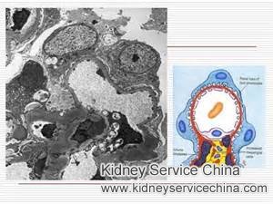 How Can I Reverse My IgA Nephropathy on Dialysis