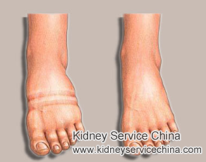 Treatments for Fluid Retention in Nephrotic Syndrome