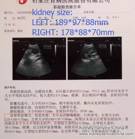 Shrink Kidney Size 4cm with Natural Treatment within a Month