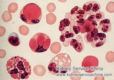 Improve Lupus Nephritic Living Condition with Toxin-Removing Therapy