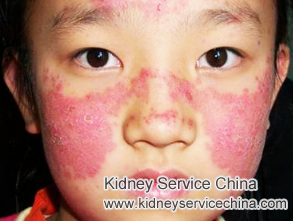 Improve Back Pain in Systematic Lupus Nephropathy with Natural Treatment