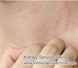 Can Skin Itching Occur in Nephritic Syndrome