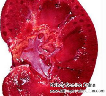 Hypertensive Nephropathy and Creatinine Level 2.1: Causes and Treatment