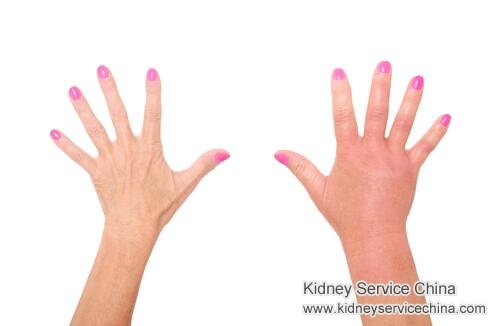 Cure Edema with Micro-Chinese Medicine in Nephrotic Syndrome